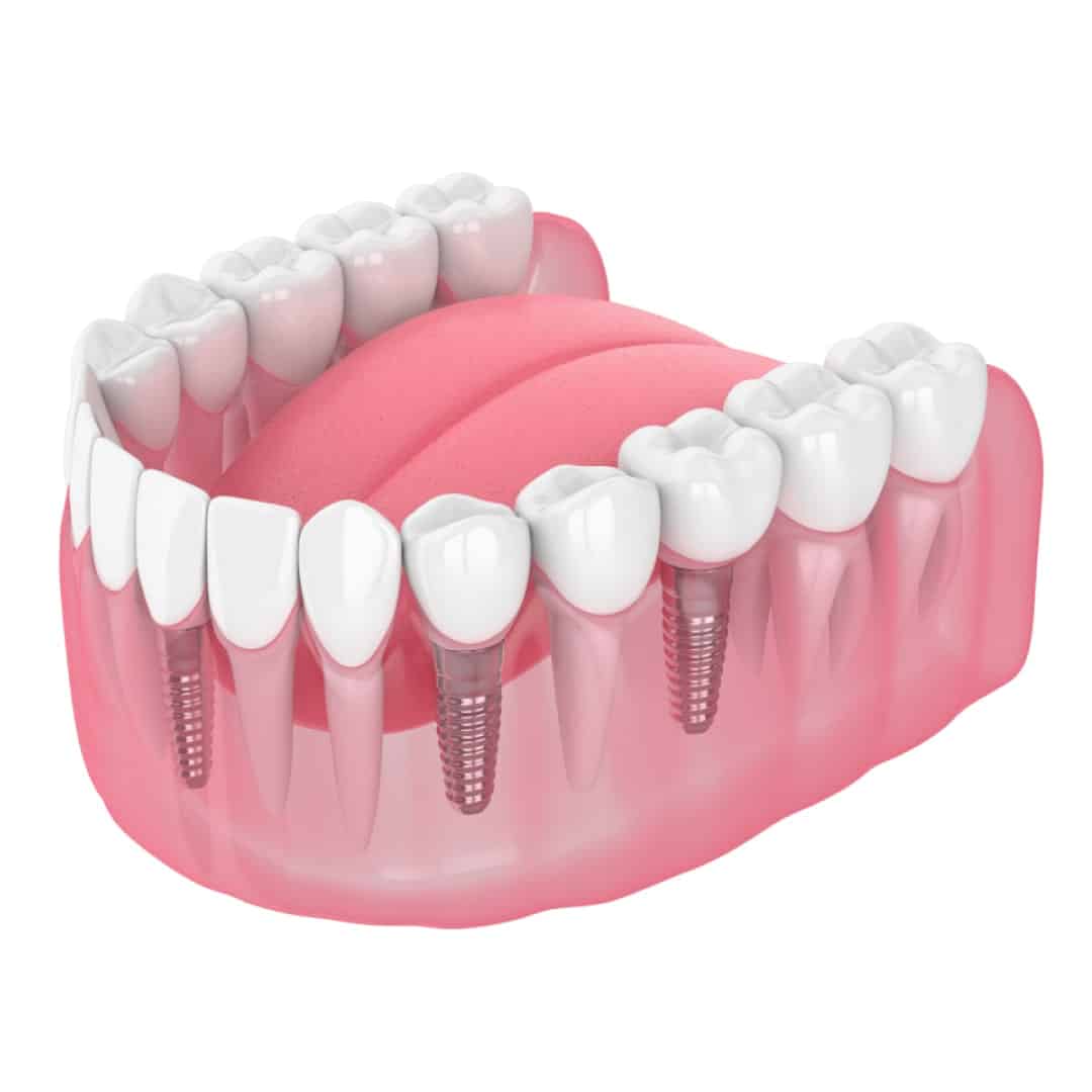 Multiple Dental Implant Multiple Dental Implant