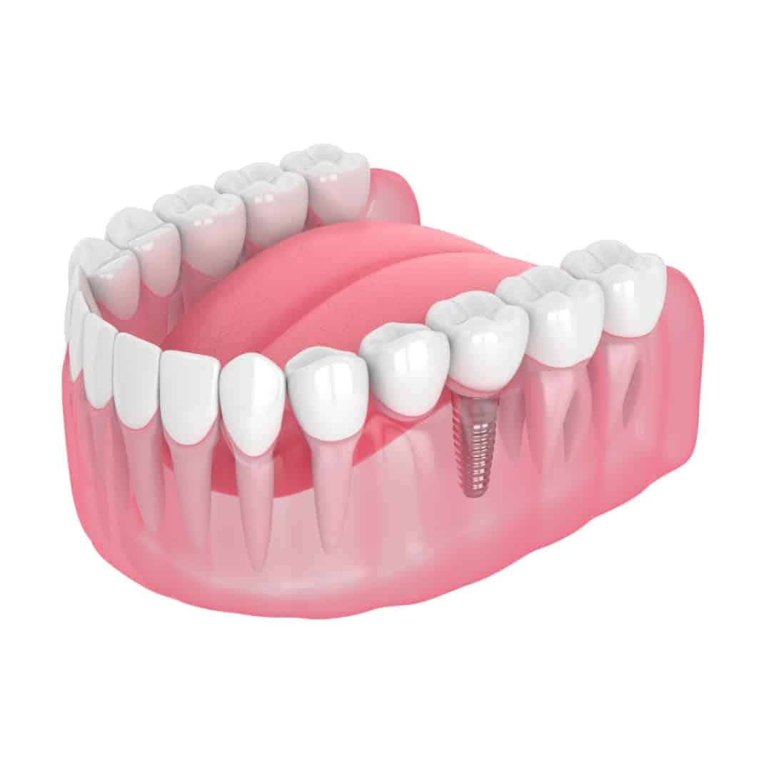 Single Dental Implant Single Dental Implant